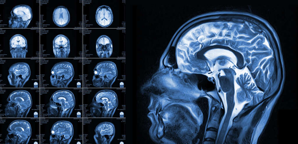 Neurocysticercosis