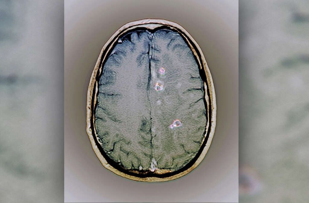 Neurocysticercosis