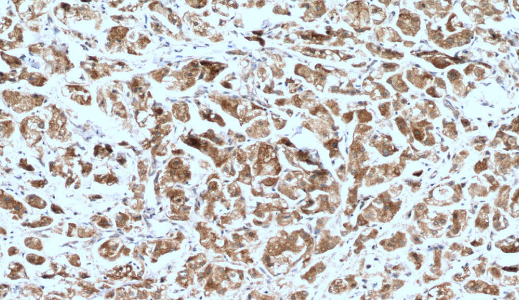 Neurofibromatosis