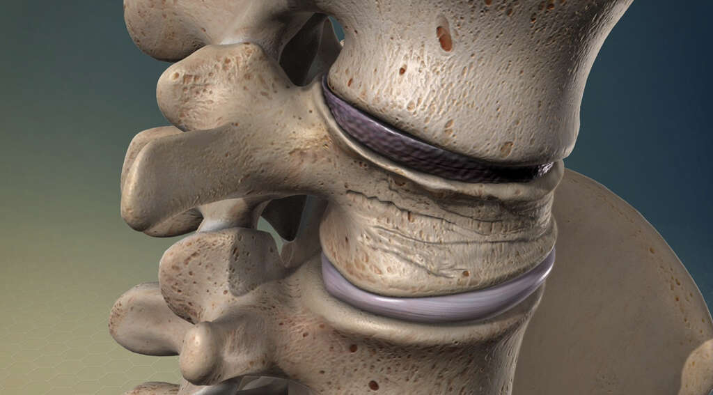 Neurofibromatosis