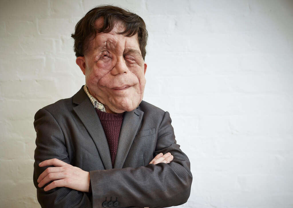 Neurofibromatosis