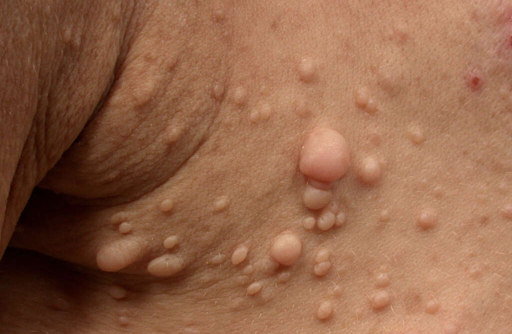 Neurofibromatosis