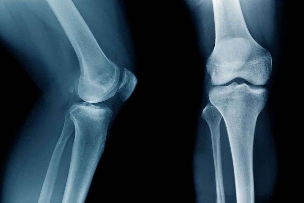 Osgood Schlatter Disease
