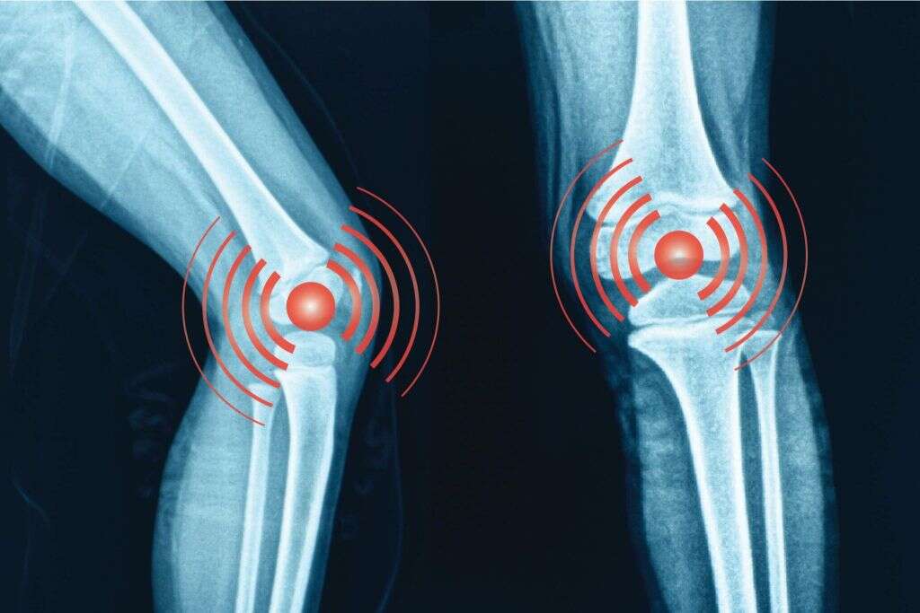 Osteoarthritis