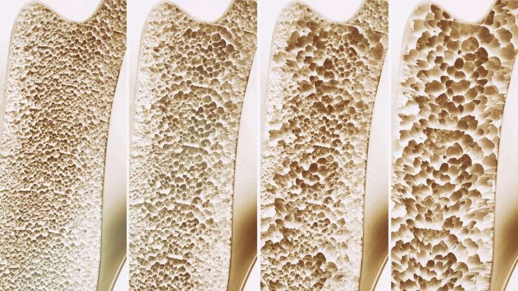 Osteogenesis Imperfecta