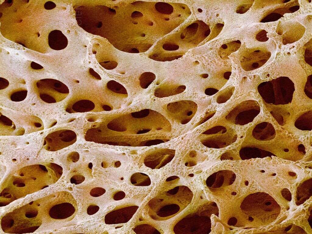 Osteoporosis