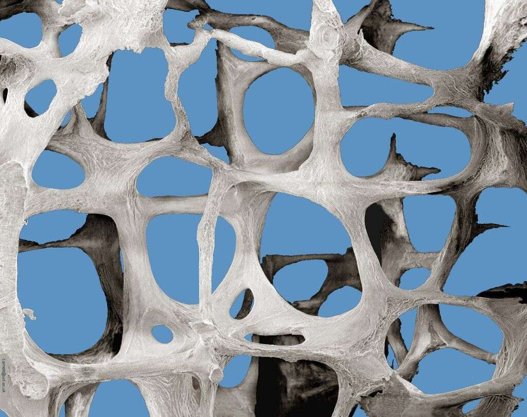 Osteoporosis