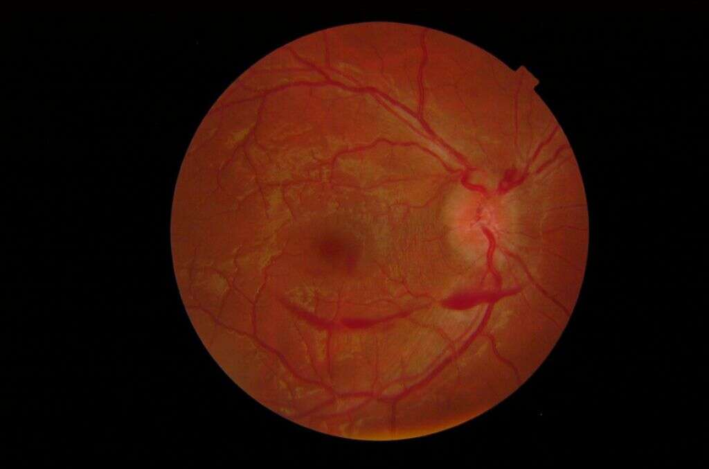Papilledema