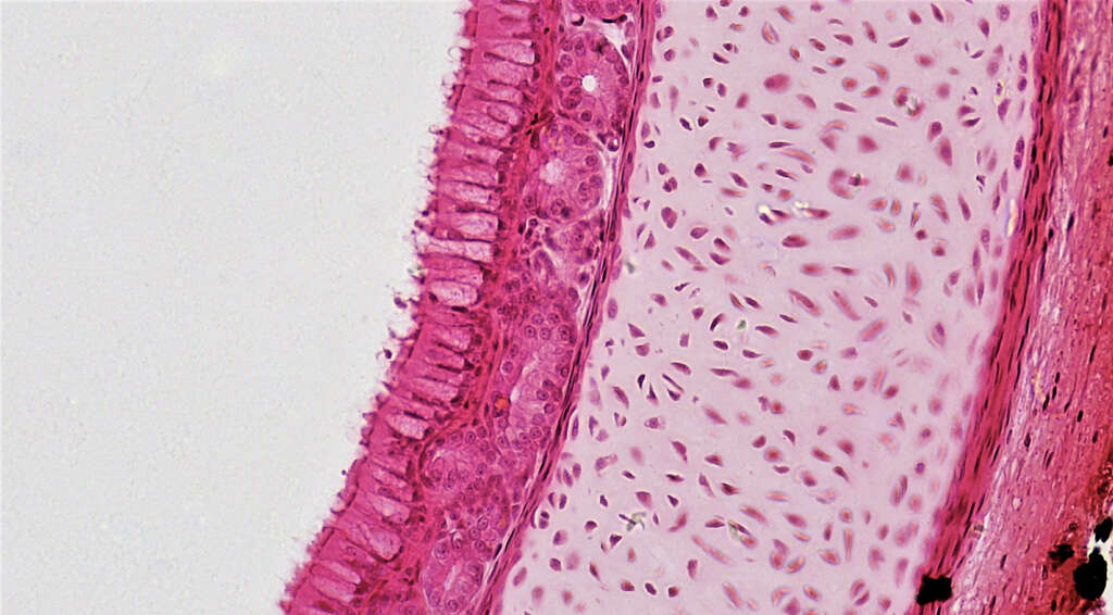 Papilloma