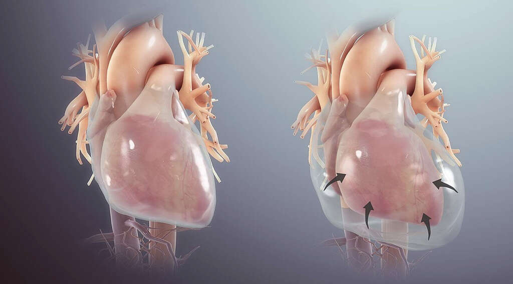 Pericarditis