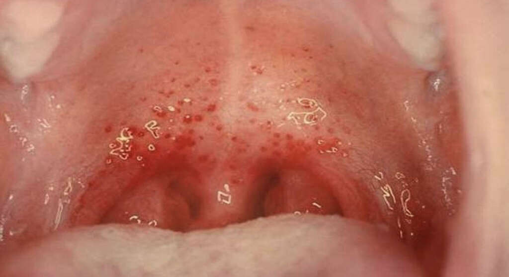 Pharyngitis