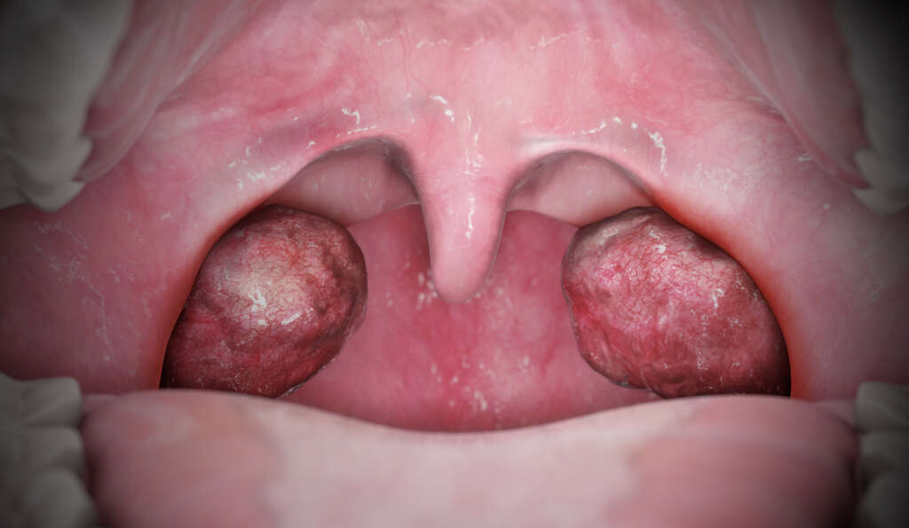 Pharyngitis