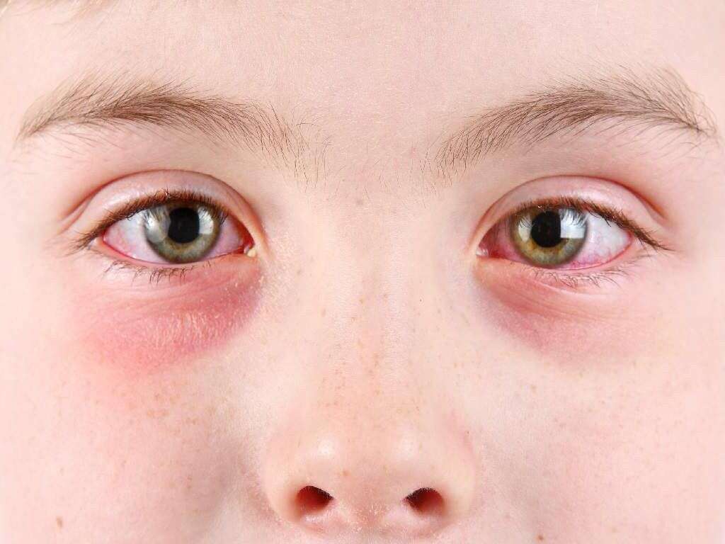 Pinkeye