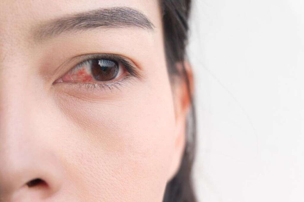 Pinkeye