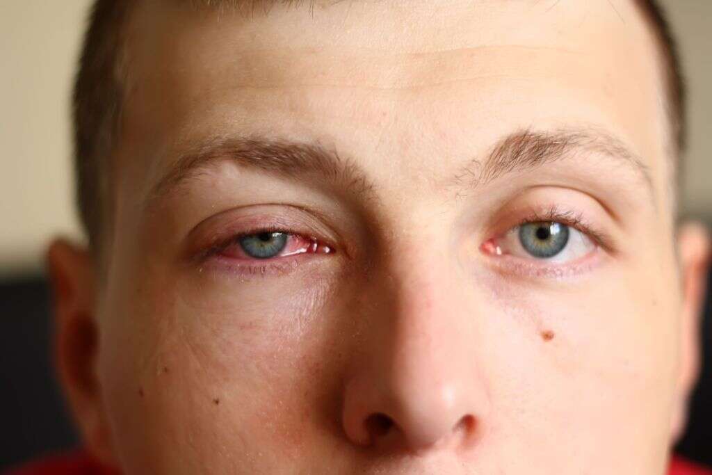 Pinkeye