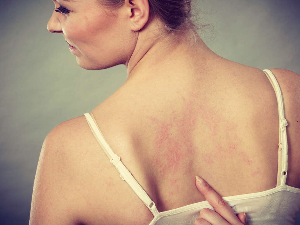 Pityriasis Rosea