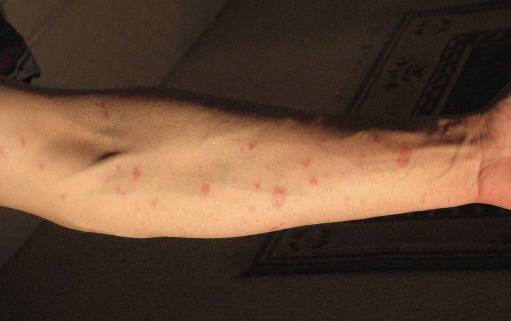 Pityriasis Rosea
