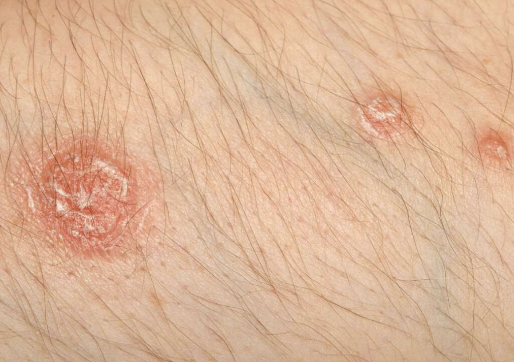 Pityriasis Rosea