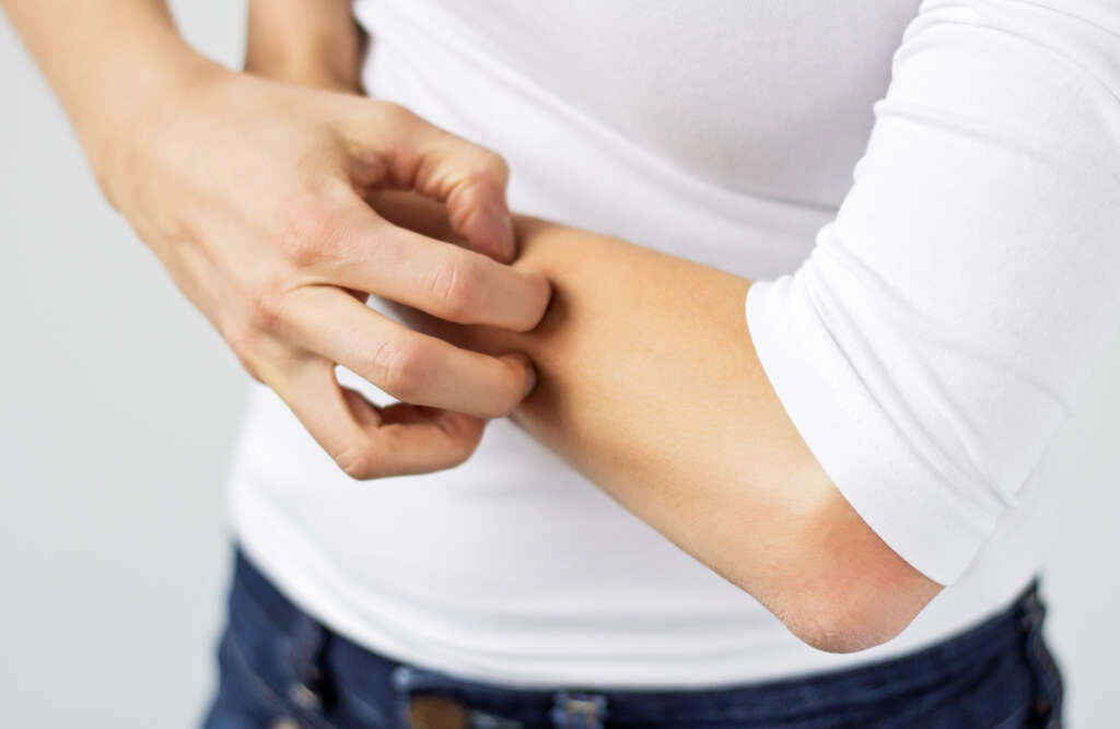Pityriasis Rosea