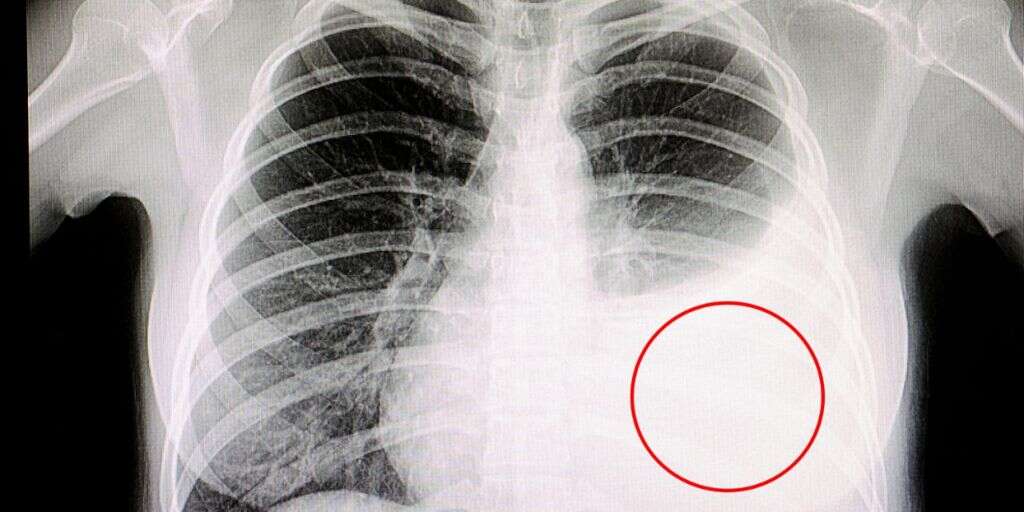 Pleural Effusion