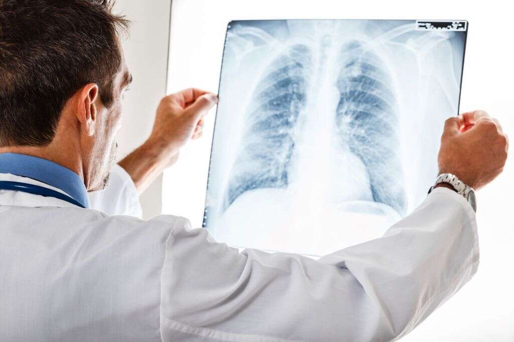 Pleural Effusion