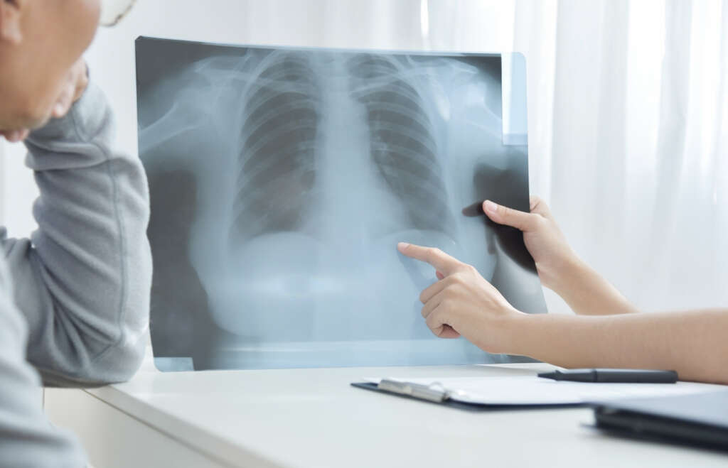 Pleurisy