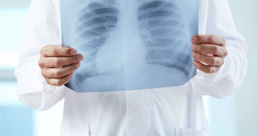 Pleurisy