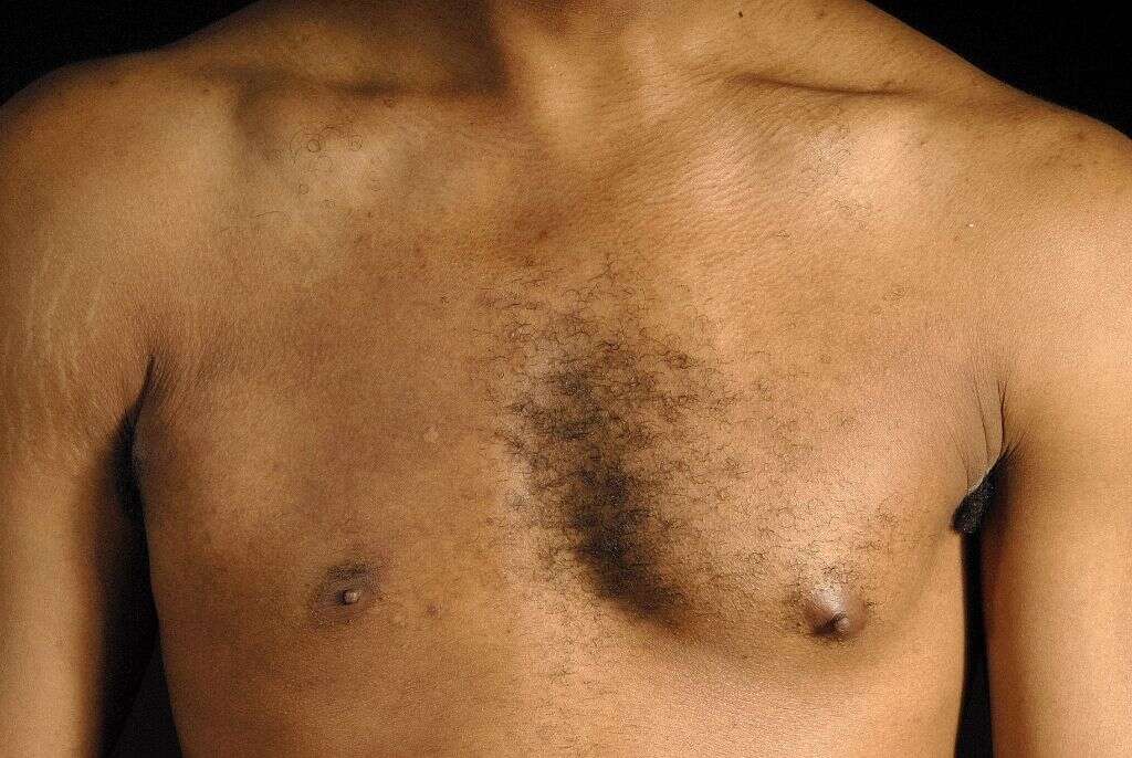 Poland Syndrome