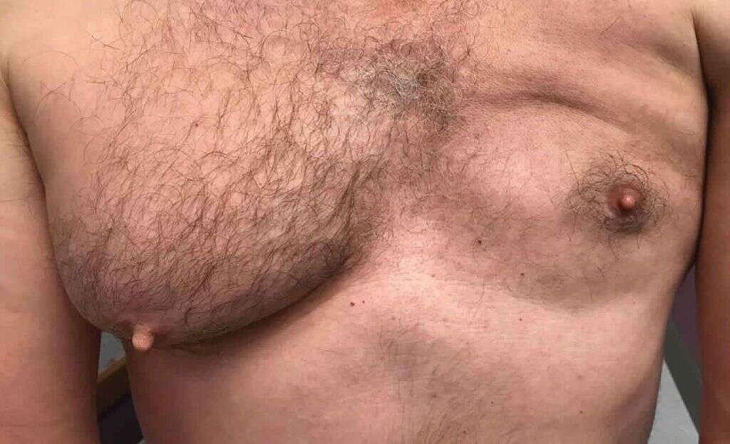Poland Syndrome