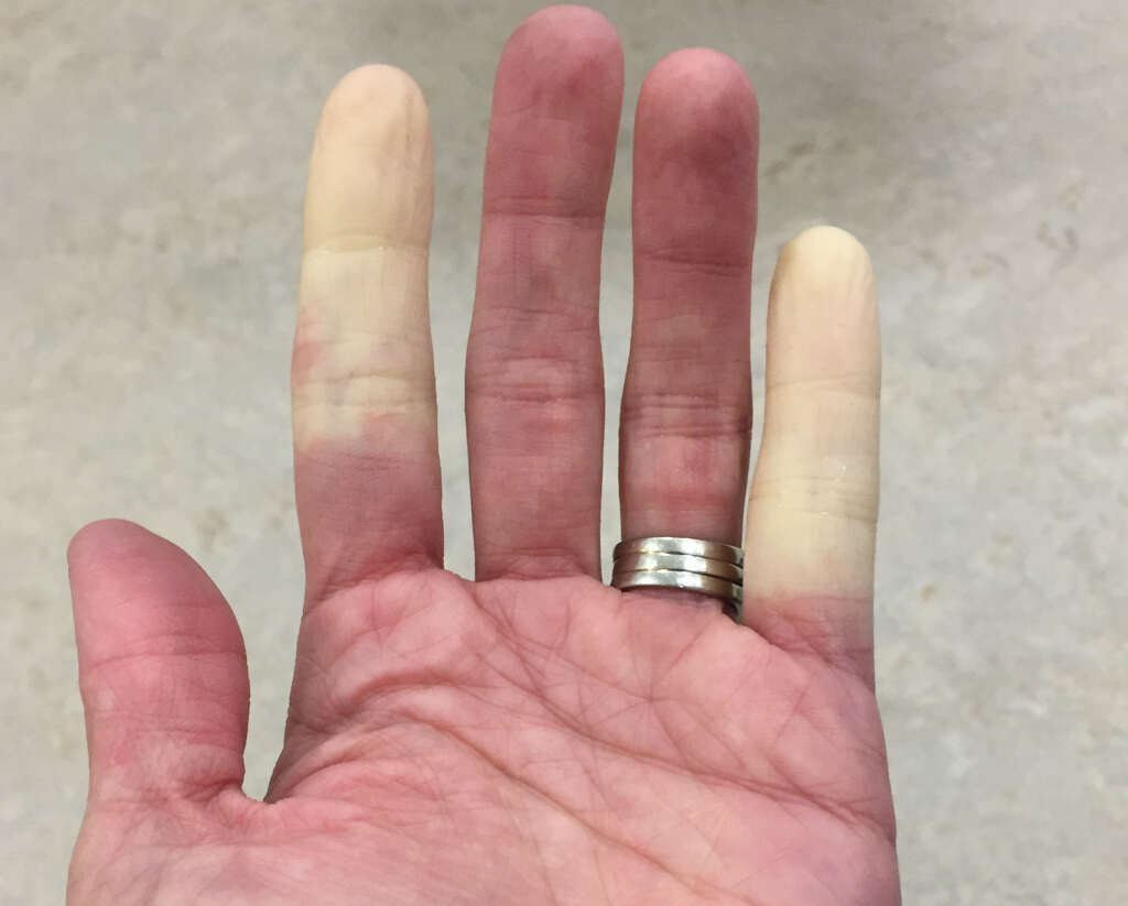 Polymyositis