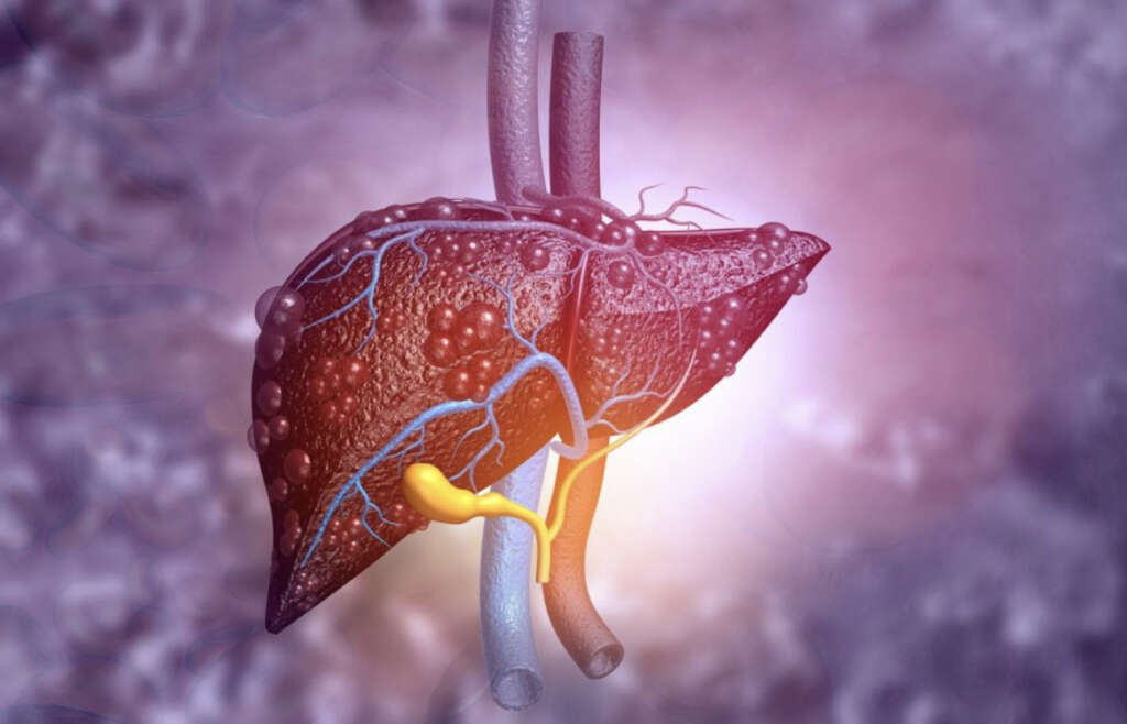 Primary Biliary Cirrhosis