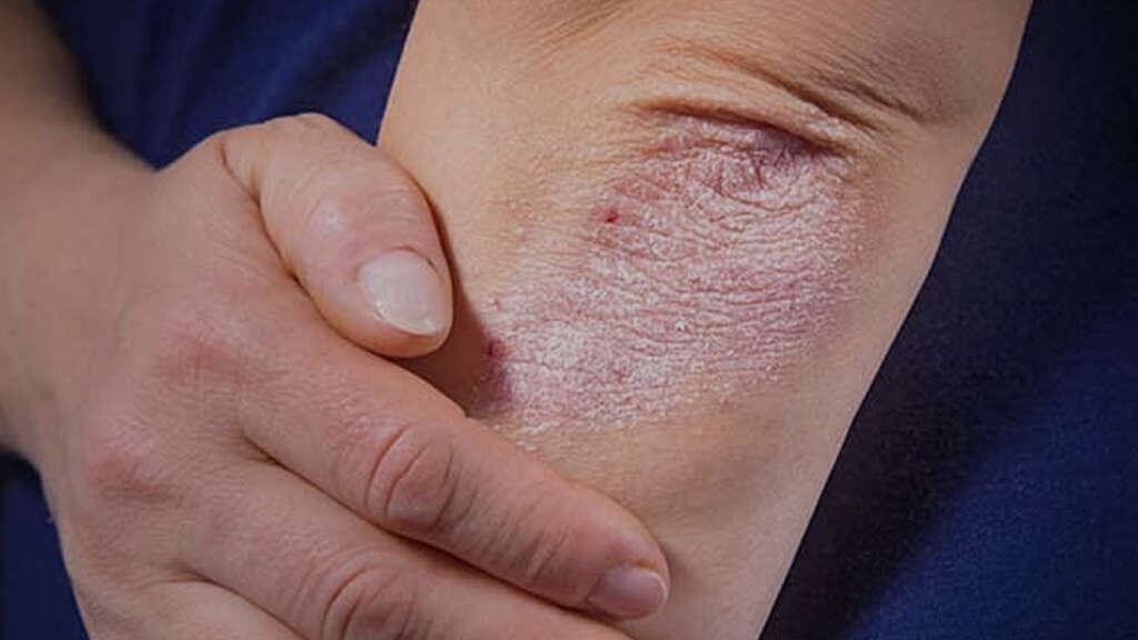 Psoriatic Arthritis