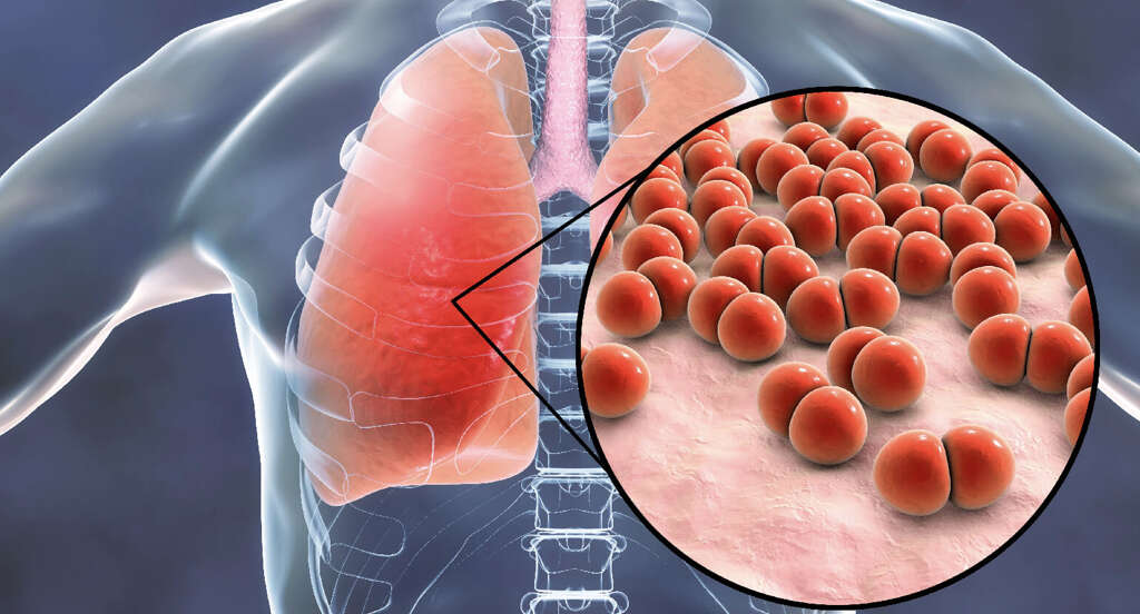 Pulmonary Fibrosis