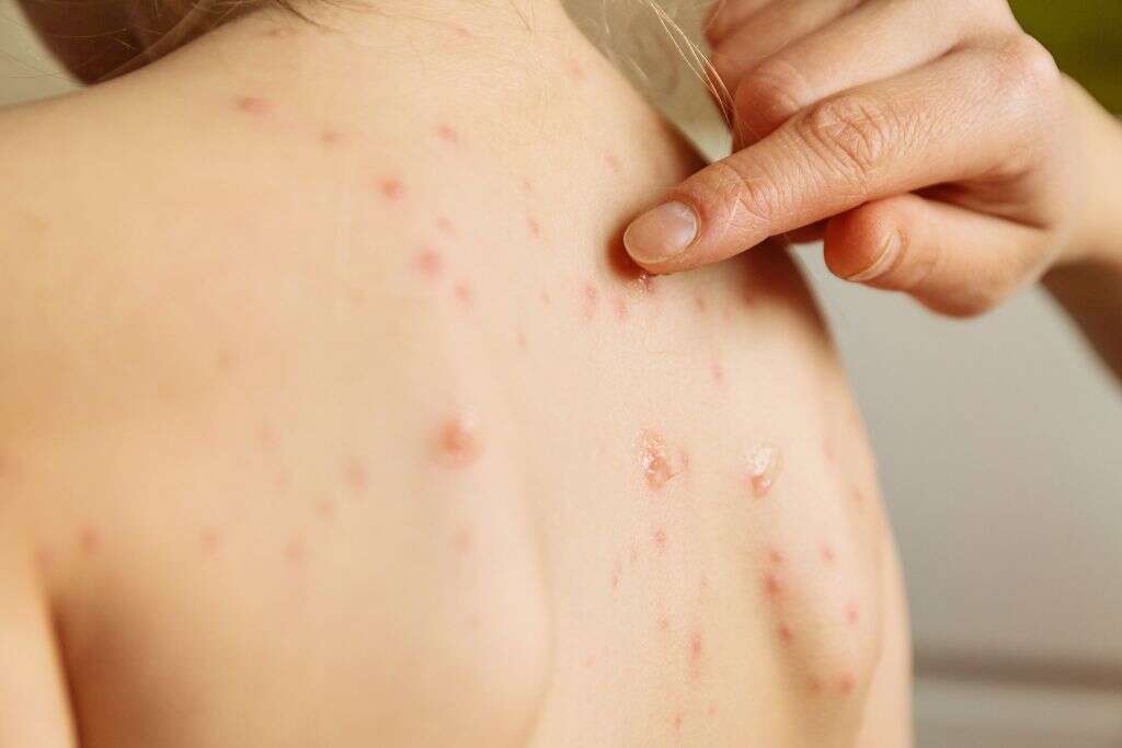 Ramsay Hunt Syndrome