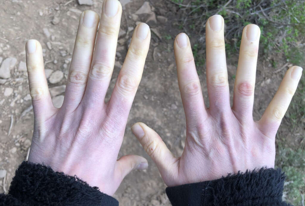 Raynaud's Syndrome
