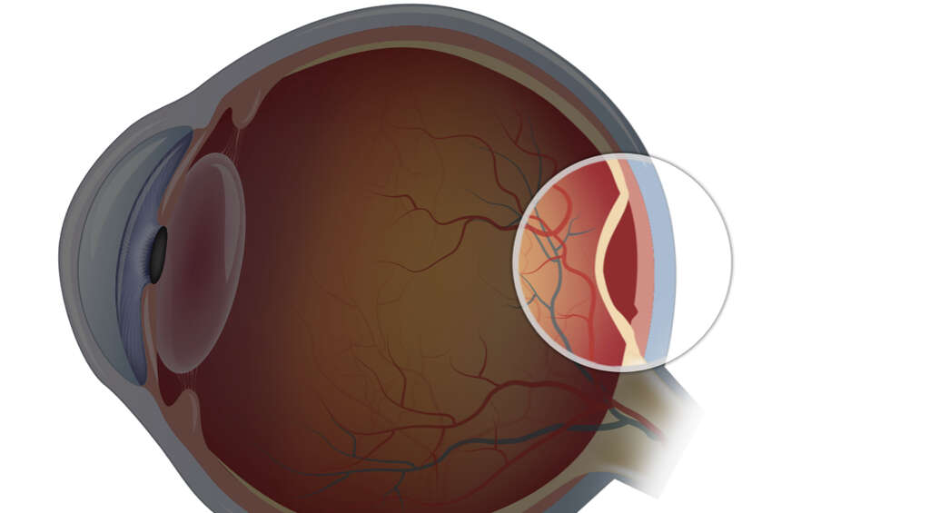 Retinal Detachment