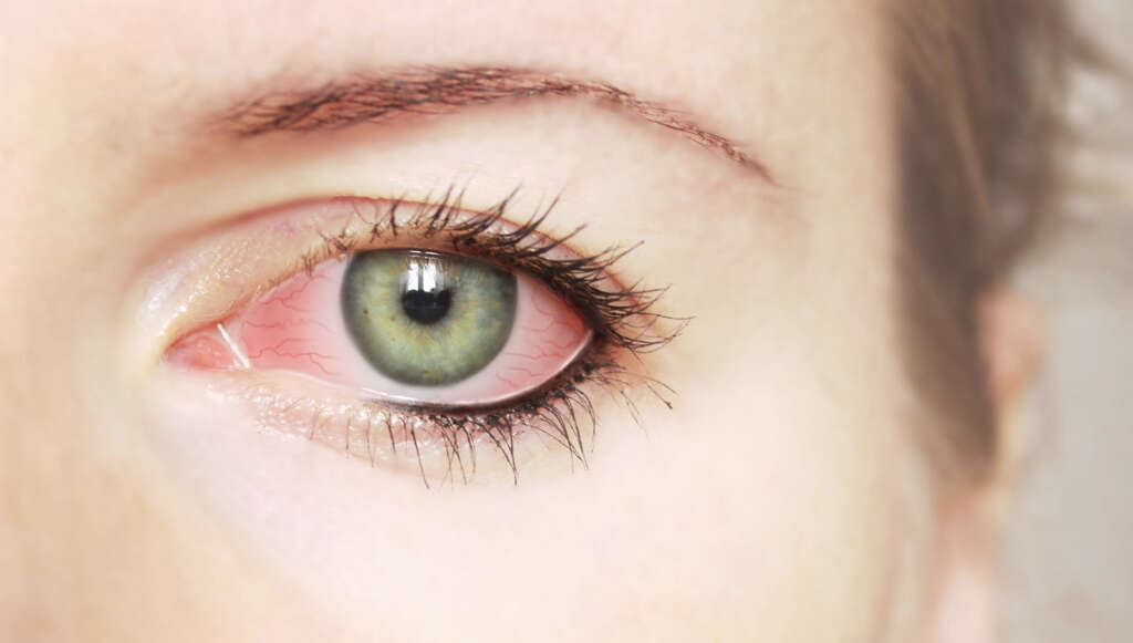 Retinal Detachment