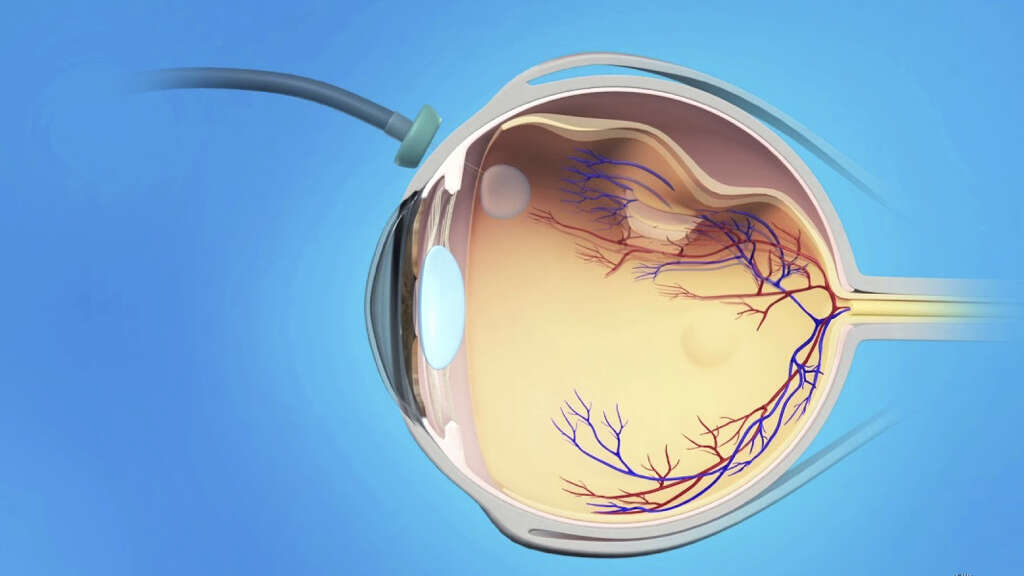 Retinal Detachment