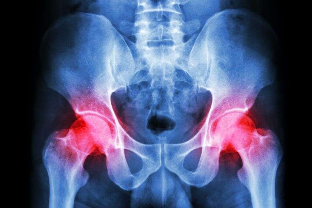 Rickets