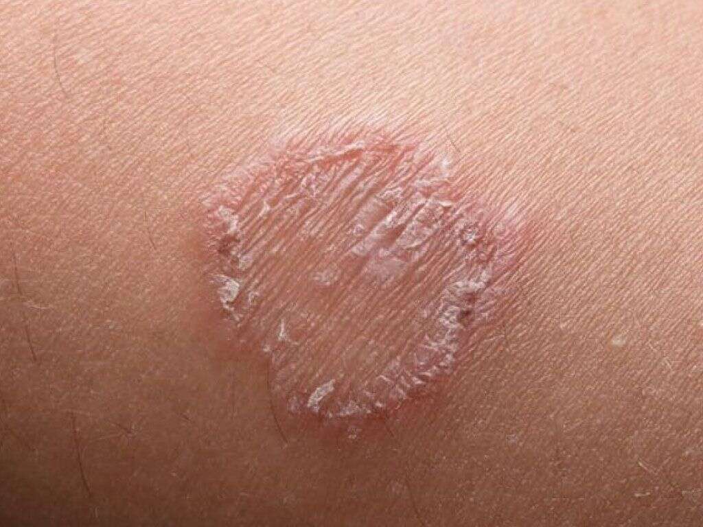 How to Identify and Treat Ringworm on a Tattoo - wide 1