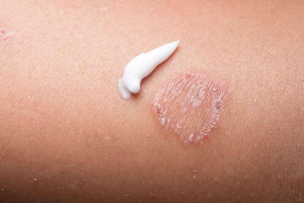 Ringworm