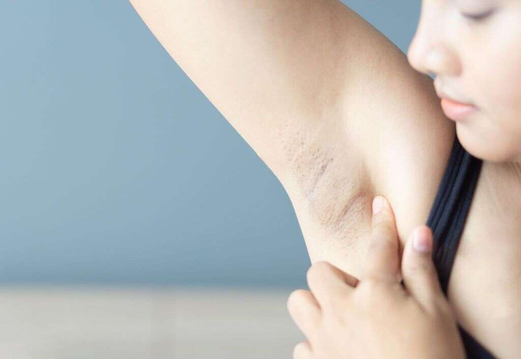 Rocky Mountain Spotted Fever