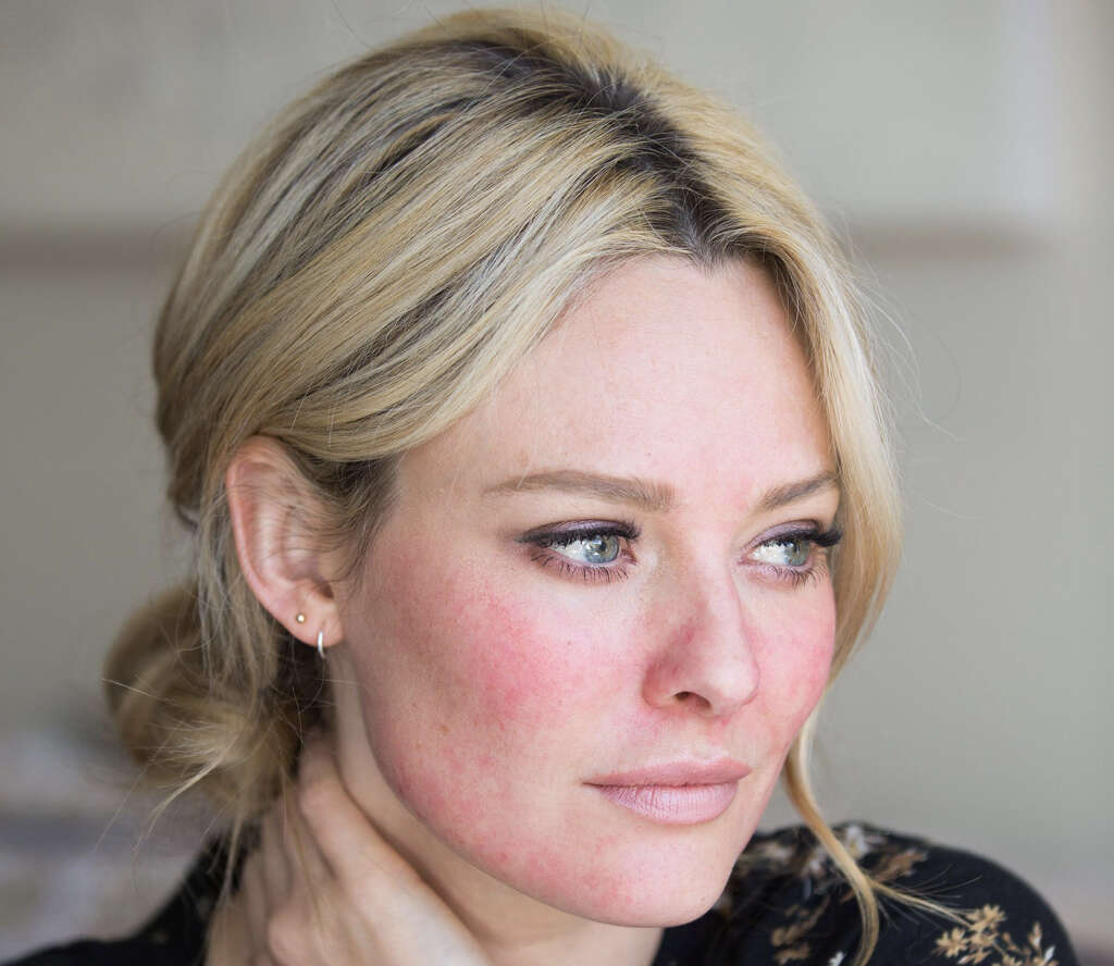 Rosacea