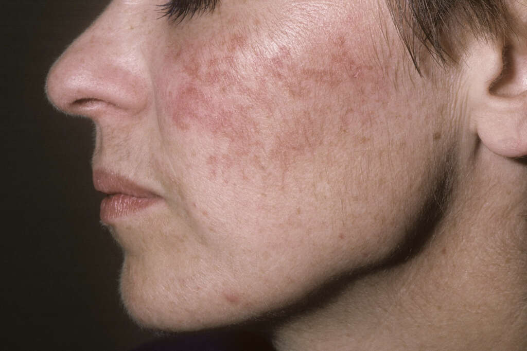 Rosacea