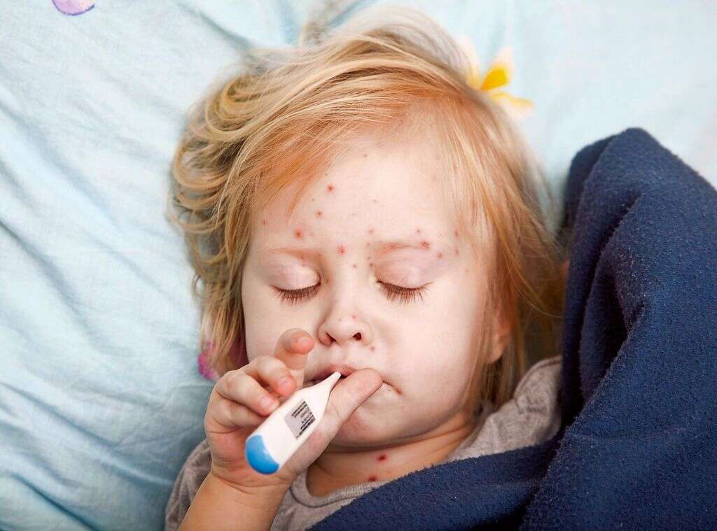 Roseola