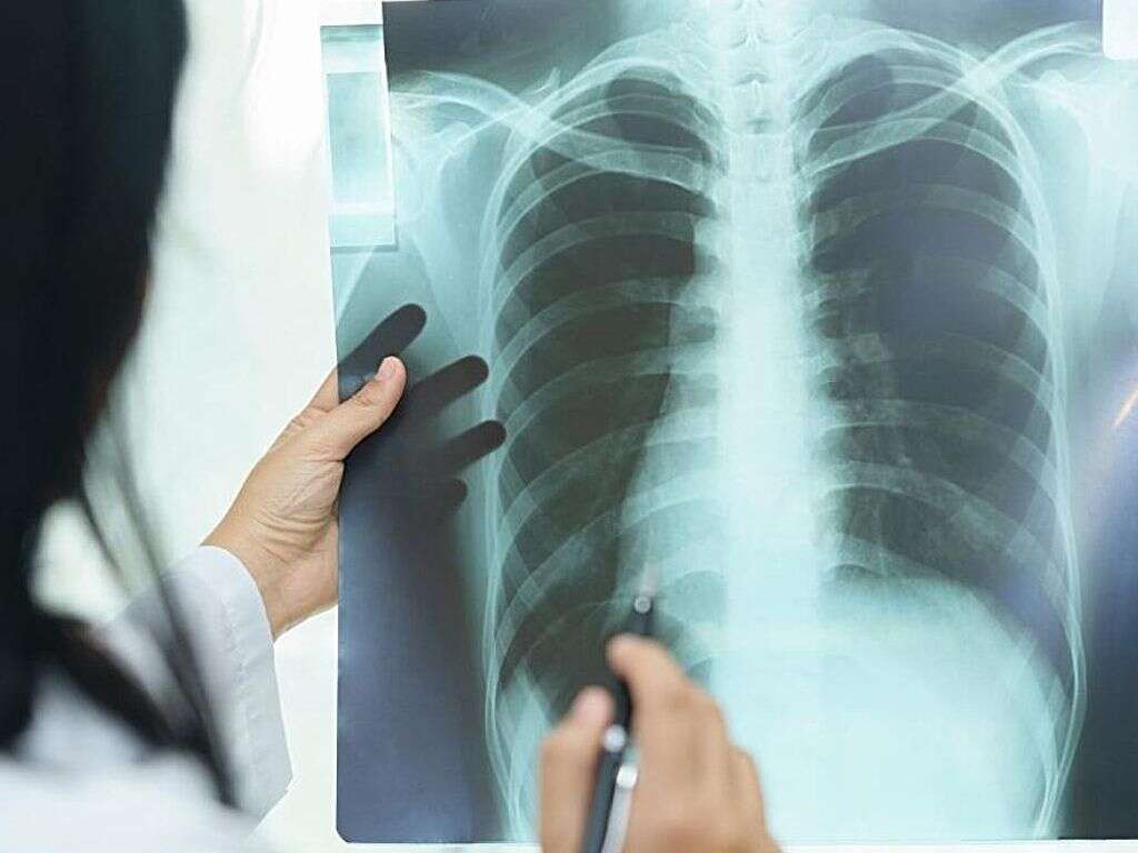 Sarcoidosis