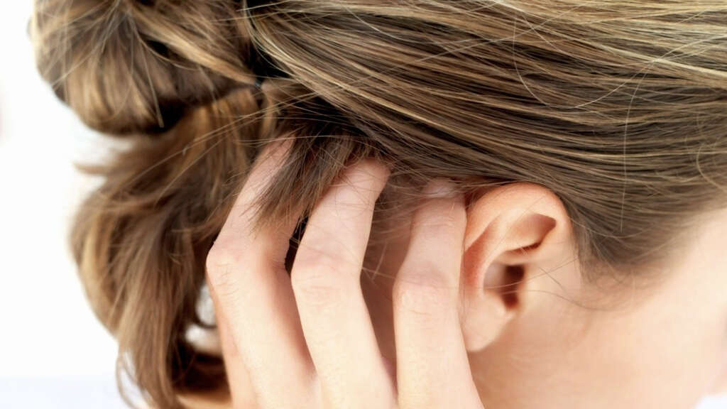 Scalp Psoriasis