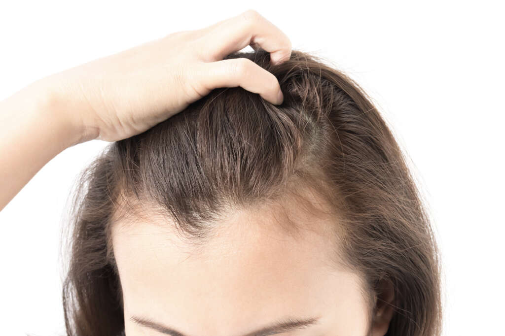 Scalp Psoriasis