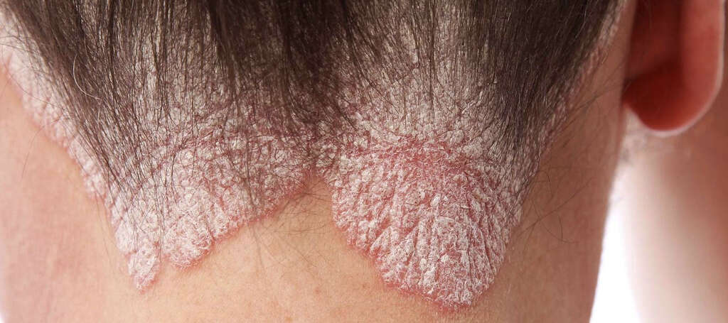 Scalp Psoriasis