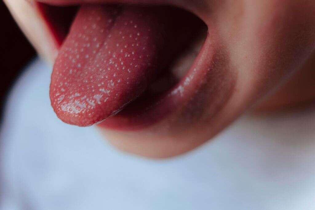 Scarlet Fever